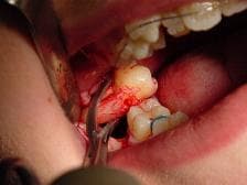 Extraction of Tooth