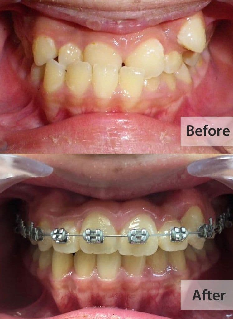 Orthodontic Treatments